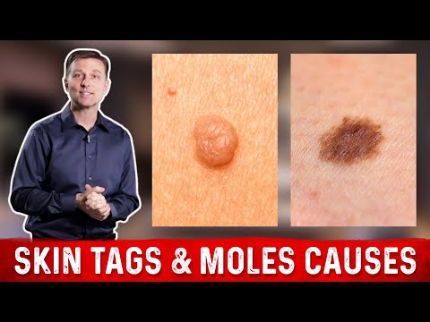 What Causes Skin Tags and Moles? – Dr.Berg