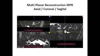 Download lagu MRI Inner EAR and Brain Differnet Sequences mp3