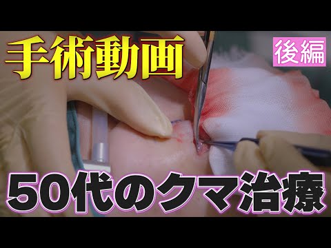 医学科 【後編】50代のクマ治療（表ハムラ法）│ほぼノーカット手術動画