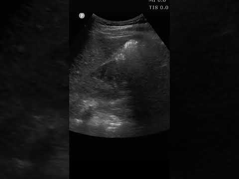 Take a deep breath #pocus #ultrasound #emergencymedicine