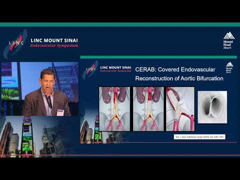 Algorithm For Treatment of Complex Aorto-Iliac CTO