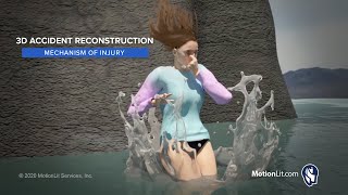 3D Animation Portrays Spinal Compression Fracture 