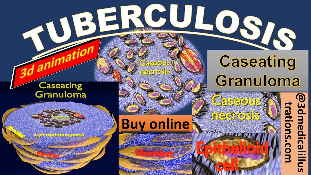3D Caseating granuolma tuberculosis labelled model 3D Model