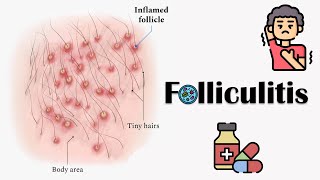 Folliculitis - Causes, Signs & Symptoms, Complications & Treatment