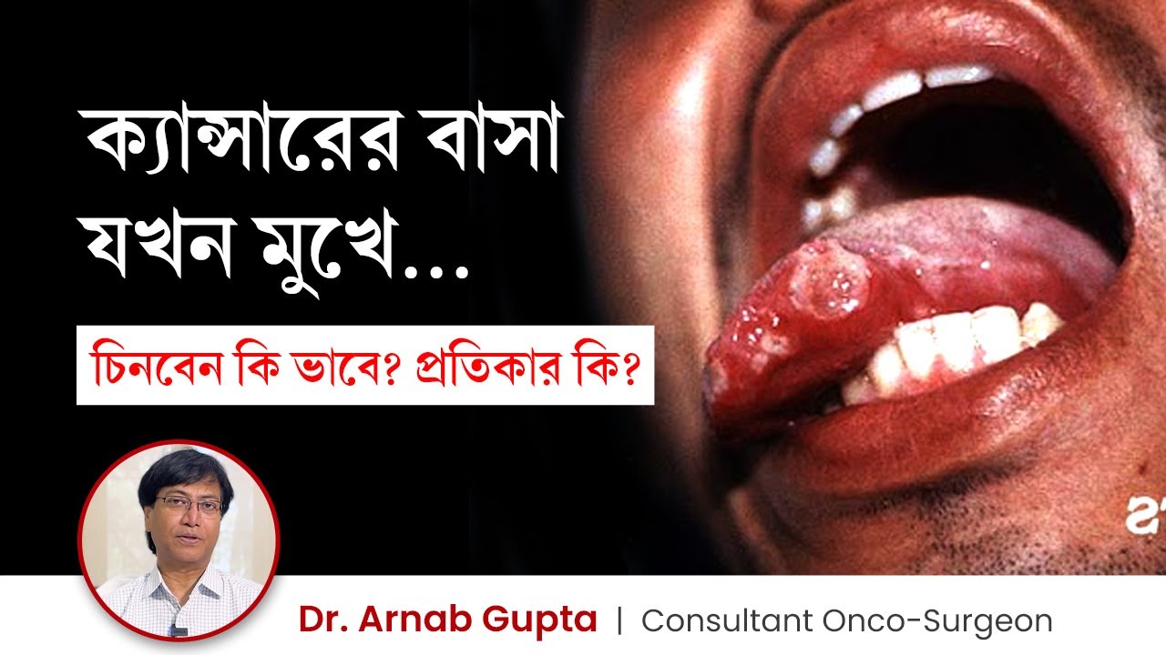 ওরাল বা মুখের ক্যান্সারের লক্ষণ কি কি? Oral cancer symptoms & treatment in Bengali