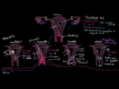 Miscarriage Basics and Types