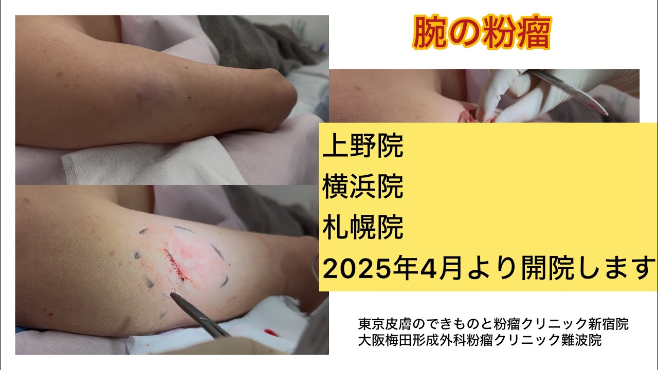 腕の粉瘤　新しく横浜院　上野院　札幌院を開院します。ブログでも粉瘤について詳しく解説してます。東京皮膚のデキモノと粉瘤クリニック　ふるばやし形成外科　東京新宿院大阪難波院　大阪梅田形成外科クリニック