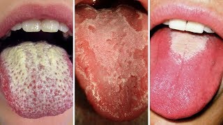 What Your Tongue Has to Say About Your Health!