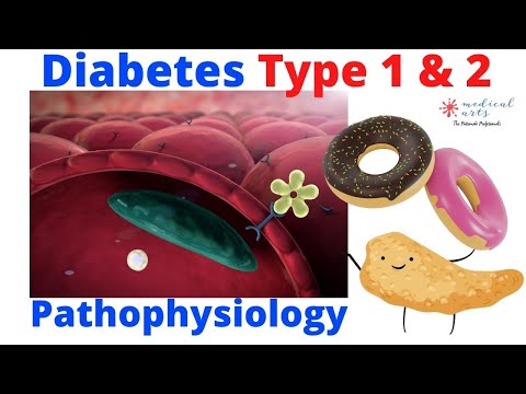 Diabetes Type1 Vs Type 2 - Pathophysiology Of Diabetes - DM1 vs DM2.