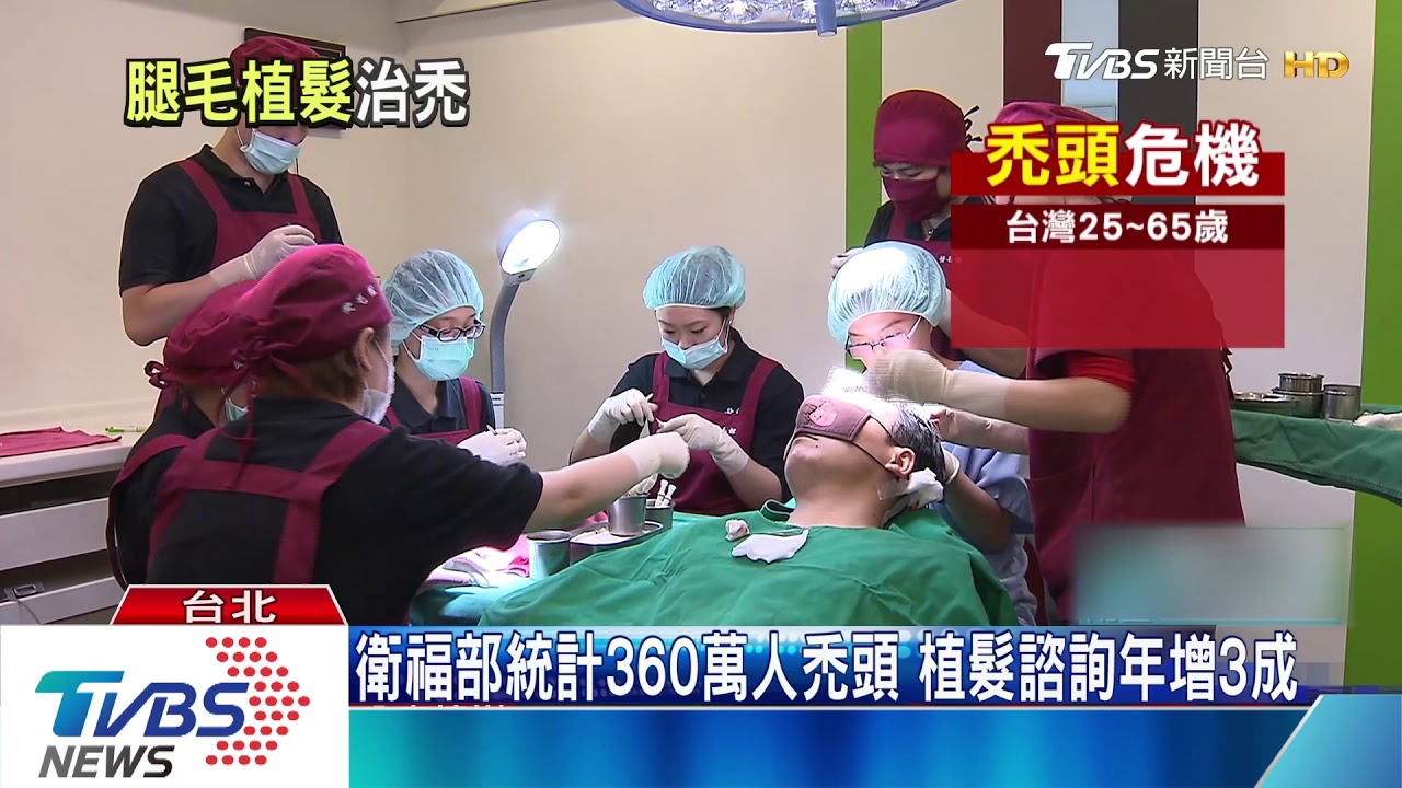 新技術!鬍子、腿毛、腋毛都能「移植」變頭髮