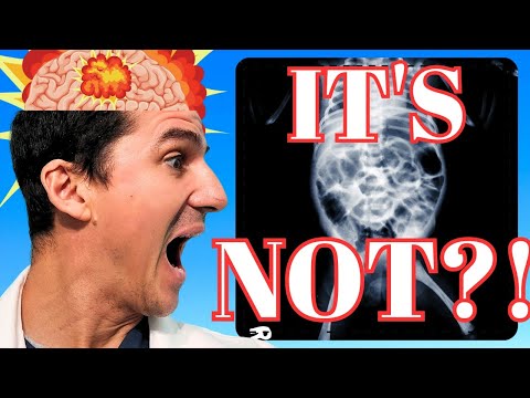 Did you know that NEC really ISN'T an infection?