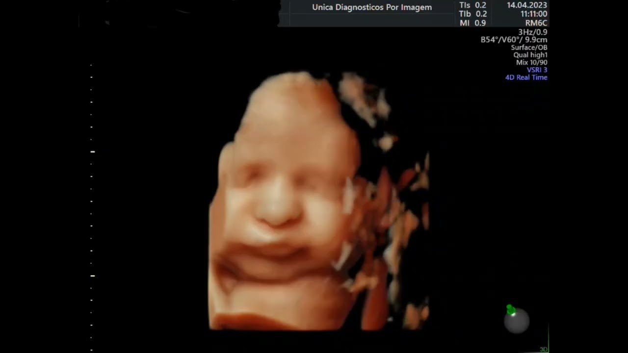 Ultrassom 4D HD Live