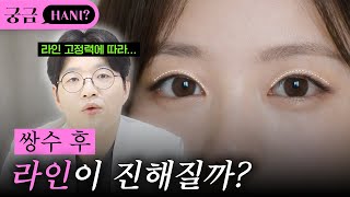 쌍수하면 눈동자 노출량도 달라질까?🤔ㅣ진실이 궁금하니?