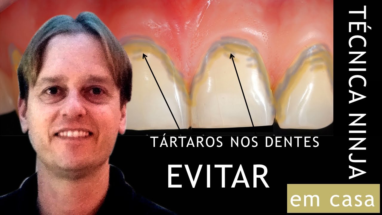 Tártaro no Dente - Como Evitar? - Técnica Ninja 2.0 Para VOCÊ FAZER EM CASA !