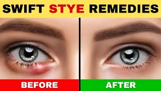 How to Get Rid of a STYE in Your Eye at Home | Natural Cures for Chalazion vs. Stye