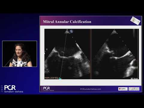 Transcatheter mitral valve replacement: patient selection and hemodynamic stability
