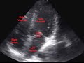 Echocardiogram of Premature Ventricular Contraction - Loop