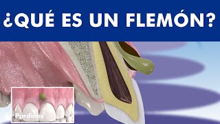 El absceso dental - Qué es un flemón y cómo se cura ©