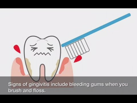 Gum Disease Stage 1: Gingivitis