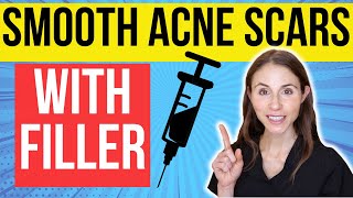 Filler For Acne Scars | Dermatologist Explains