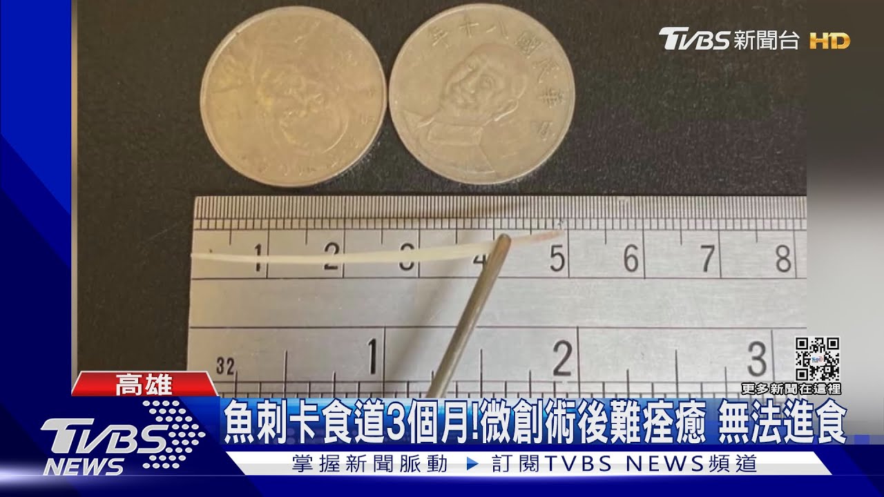 魚刺卡食道3個月!微創術後難痊癒 無法進食