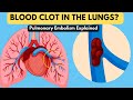 Pulmonary Embolism Explained In 3 Minutes Symptoms Diagnosis Treatment