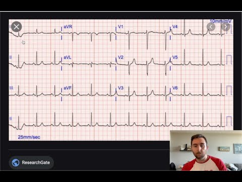 EKG 101 - "Rhythm" - Part 3/7