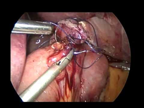 Résection laparoscopique d'une tumeur stromale gastrique après une gastrectomie partielle précédente avec reconstruction Billroth II
