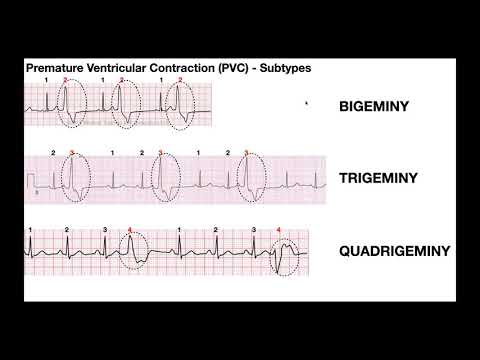 EKG Patterns | Premature Atrial & Ventricular Contractions [PACs & PVCs]