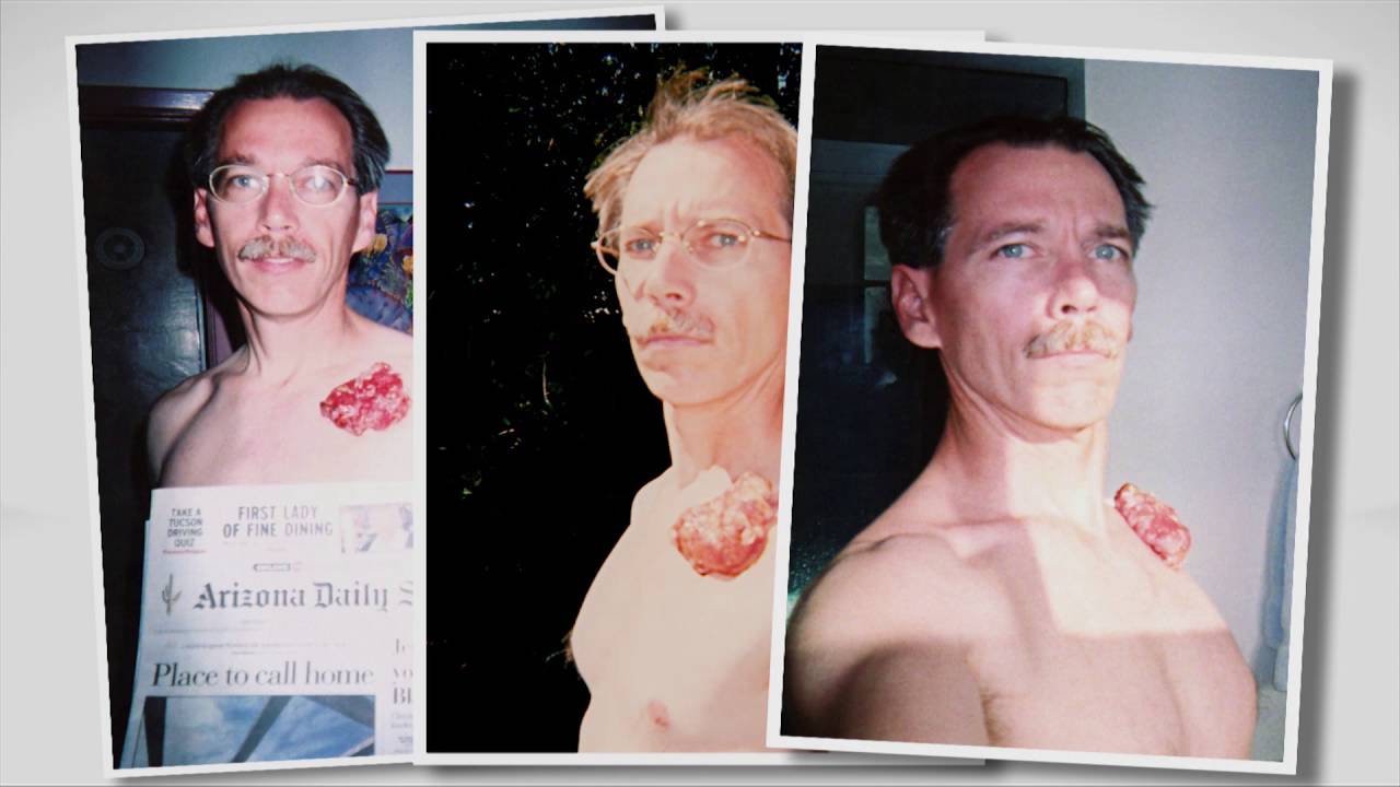 Mike hoesch, journey with cancer thumbnail