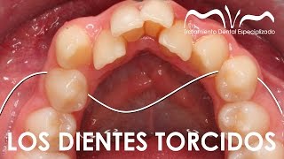 ¿POR QUÉ NOS SALEN LOS DIENTES TORCIDOS | APIÑAMIENTO DENTAL