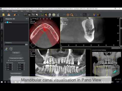 QuickVision 3D - Mandibular canal drawing - OWANDY RADIOLOGY