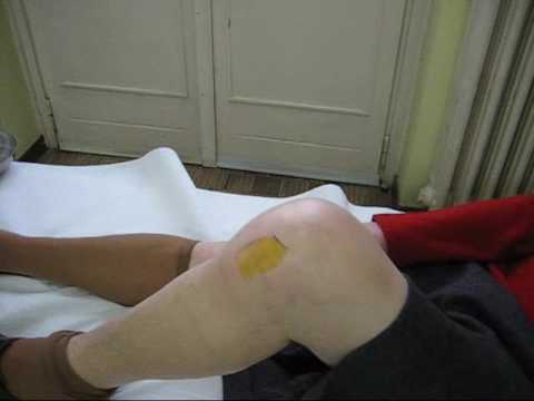 Spine trattamento tubercolosi ossea Codice ICD per lartrosi del ginocchio