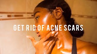 How to Get Rid of Acne Scars in a Week !!!