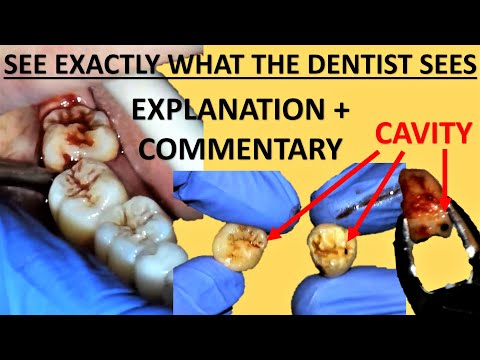 Upper and Lower Right Wisdom Tooth Removal (Extraction) - Full Surgery Walkthrough
