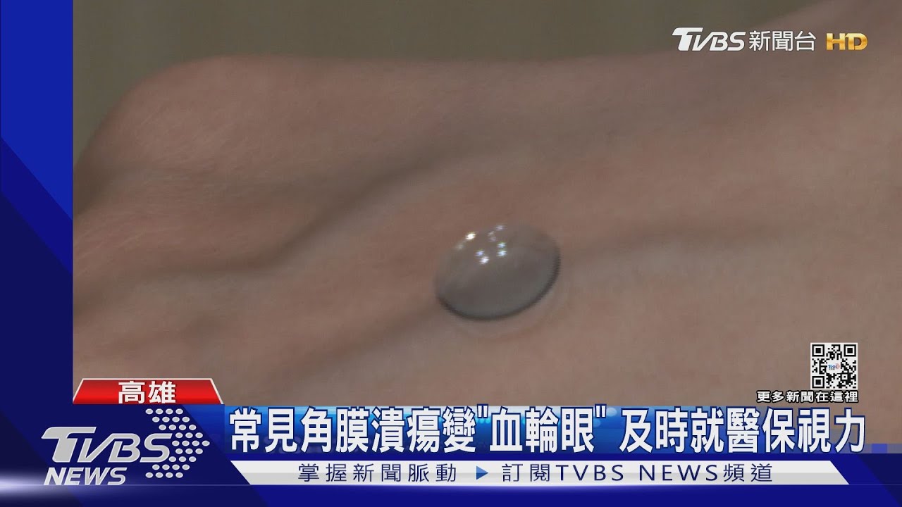 陸生戴「角膜塑型片」染阿米巴原蟲 跨海視訊台灣治療