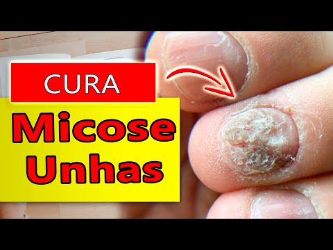 3 ÓLEOS ESSENCIAIS [Provados pela Ciência] CURAM a MICOSE NAS UNHAS dos PÉS e MÃOS em POUCO TEMPO!
