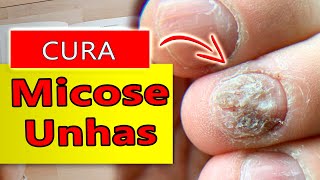 🦶Como ACABAR C/ a MICOSE NAS UNHAS usando ÓLEOS ESSENCIAIS e CURAR em POUCO TEMPO! !