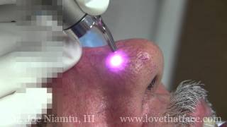 Laser Facial Spider Vein Treatment with Demonstrated by Dr. Joe Niamtu, III