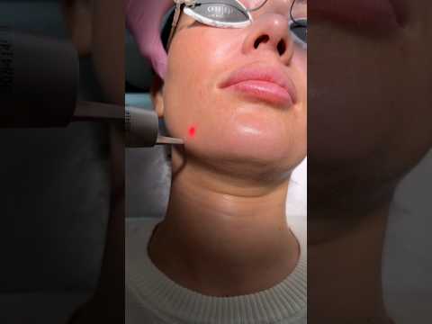 Got Picosure Laser to treat my melasma and as you can see there’s very minimal downtime. #skincare