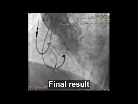 A step-by-step TAVI using Portico FlexNav system