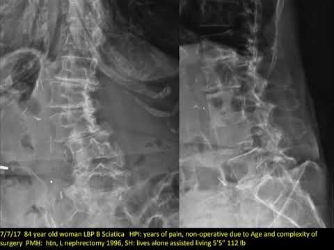 Spine Conference: complications associated with BMP