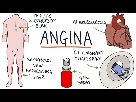 Understanding Angina: Visual Explanation for Students