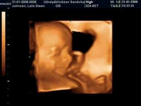 3D ultralyd / ultrasound