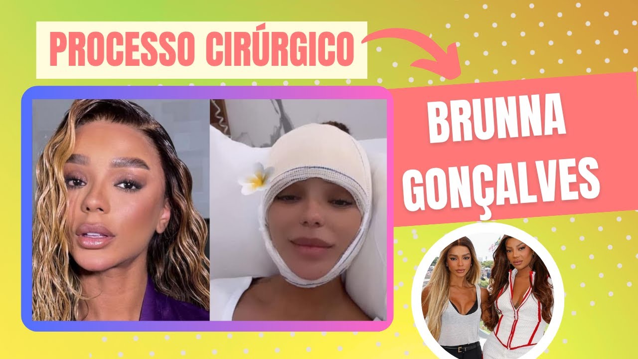 Revelado  A Transformação de Brunna Gonçalves   O Sonho Realizado da Frontoplastia!