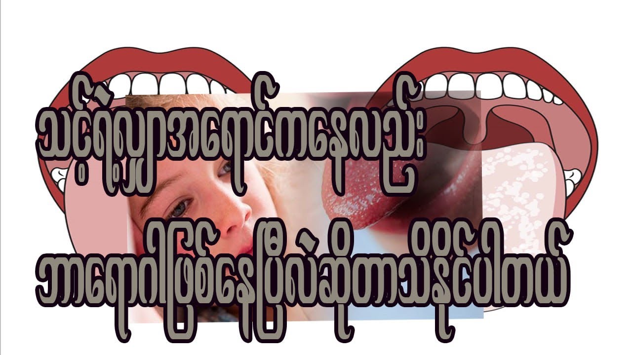 သင့်ရဲ့လျှာအရောင်ကနေလည်းဘာရောဂါဖြစ်နေပြီလဲဆိုတာသိန်ုင်ပါတယ်