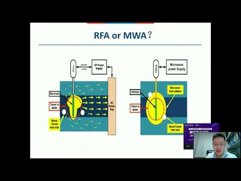 CCMA & SIO Webinar _ Prof. Yang-kui Gu: MDT Based Ablation Strategy of Colorectal Liver Metastases