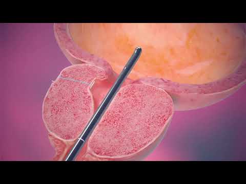 MCI 2022 0071 IN UR Video, Procedure Animation, UroLift 2 JP APAC 1