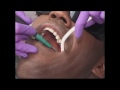 Ultrasonic Scaling | Lake Merritt Dental, Oakland, CA
