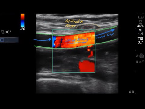 Case 245: RLQ pain, Normal #Appendix, Dilated Ureter, UVJ Stone, #POCUS